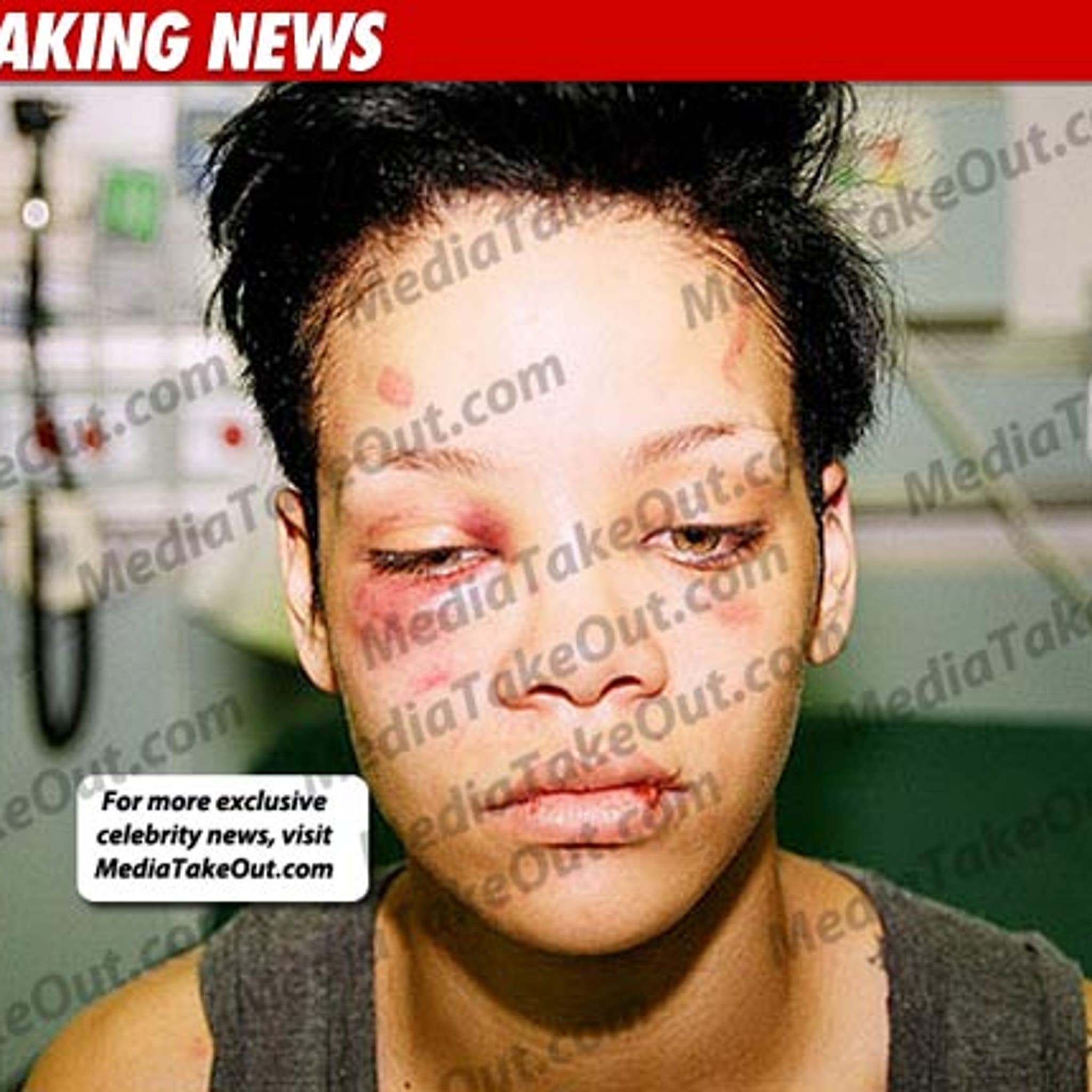 Pictures Of Rihannas Facial Injuries Telegraph