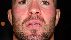 Photo Of Colby Covington's Broken Tooth Revealed After Alleged Jorge Masvidal Attack