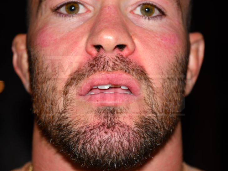 Colby Covington's Alleged Injuries