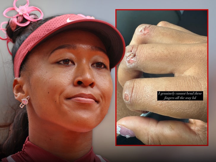 Naomi Osaka Knuckle injury Main Getty Instagram Composite