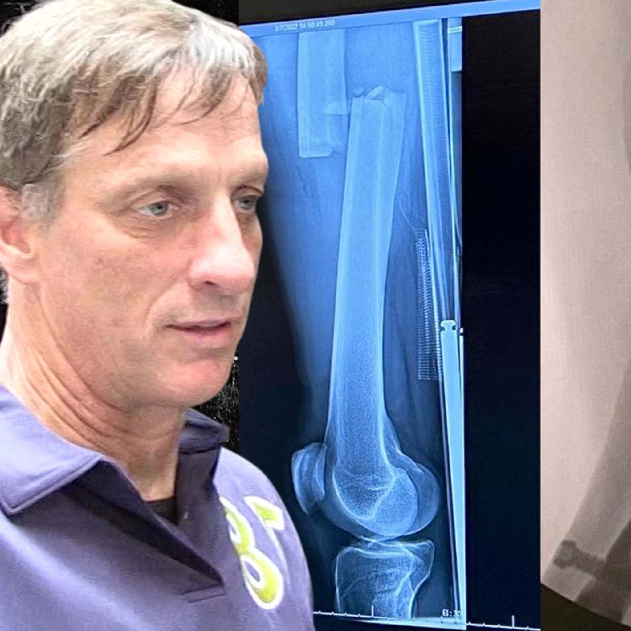 Tony Hawk Suffers Severe Broken Leg In Skating Accident