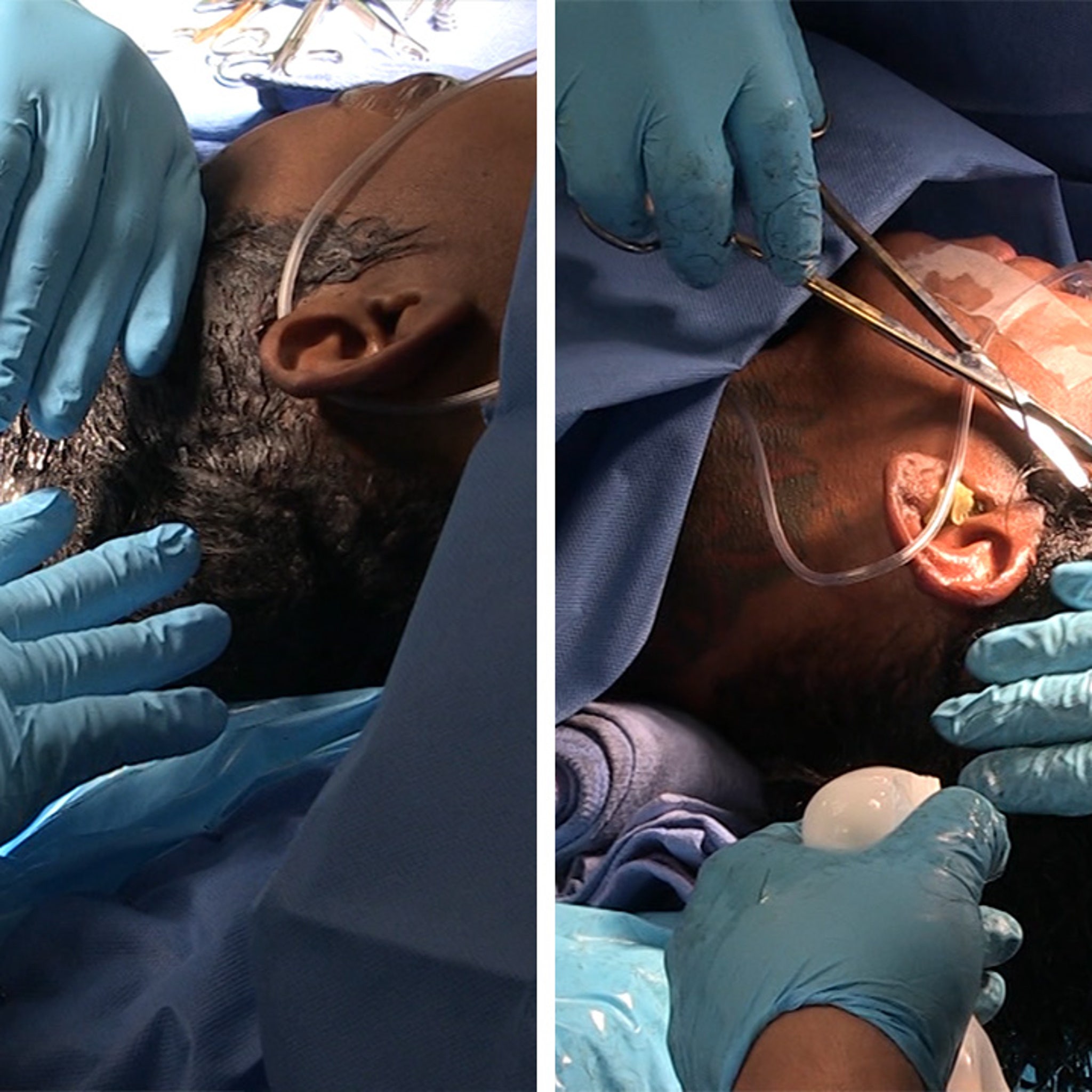 Tessica Brown Gets Gorilla Glue Out of Hair, Video of Surgery