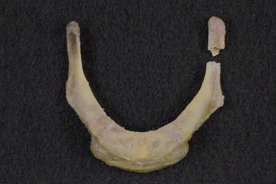 Epstein's autopsy report found his neck had been broken in several places, including the hyoid bone located near the Adam's apple