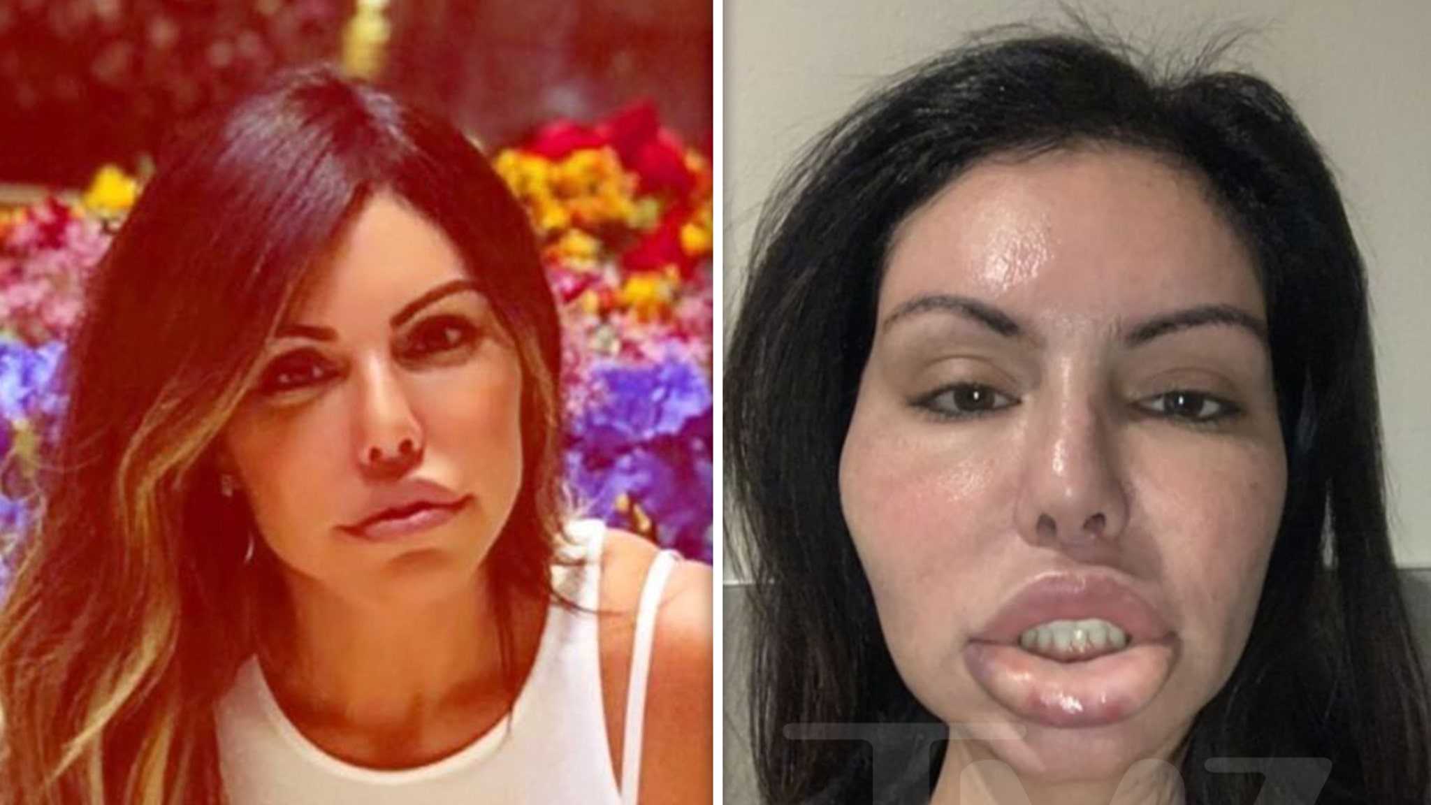 Liziane Gutierrez Suffers Face Swell After Another Botched Plastic Surgery.