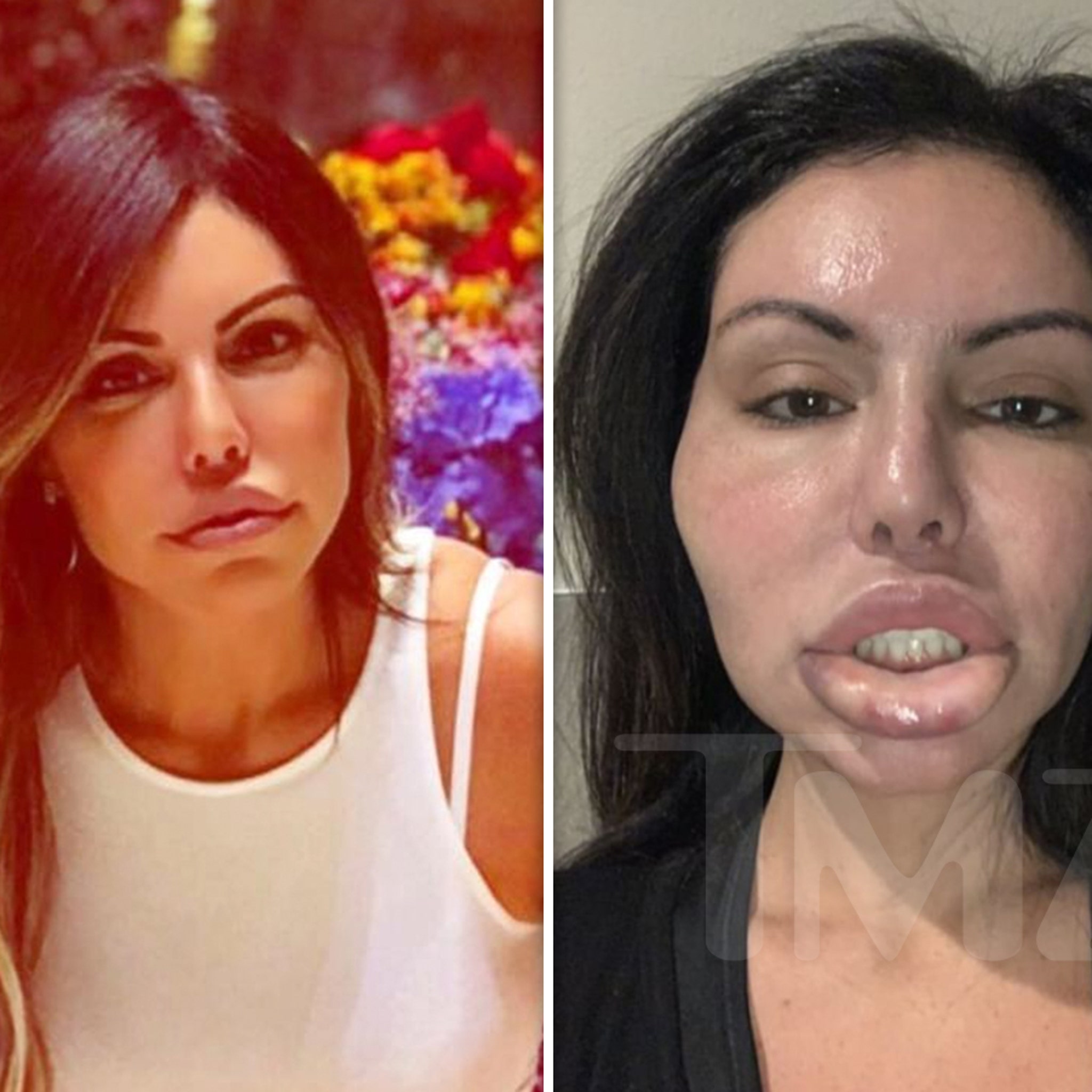 Celeb plastic surgery nightmare tmz