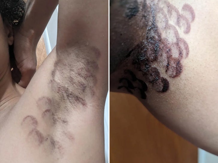 New You Laser Sued, Woman Claims Procedure Burned Her