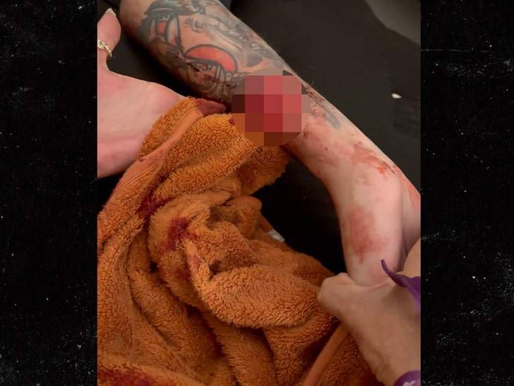 dillon danis injury