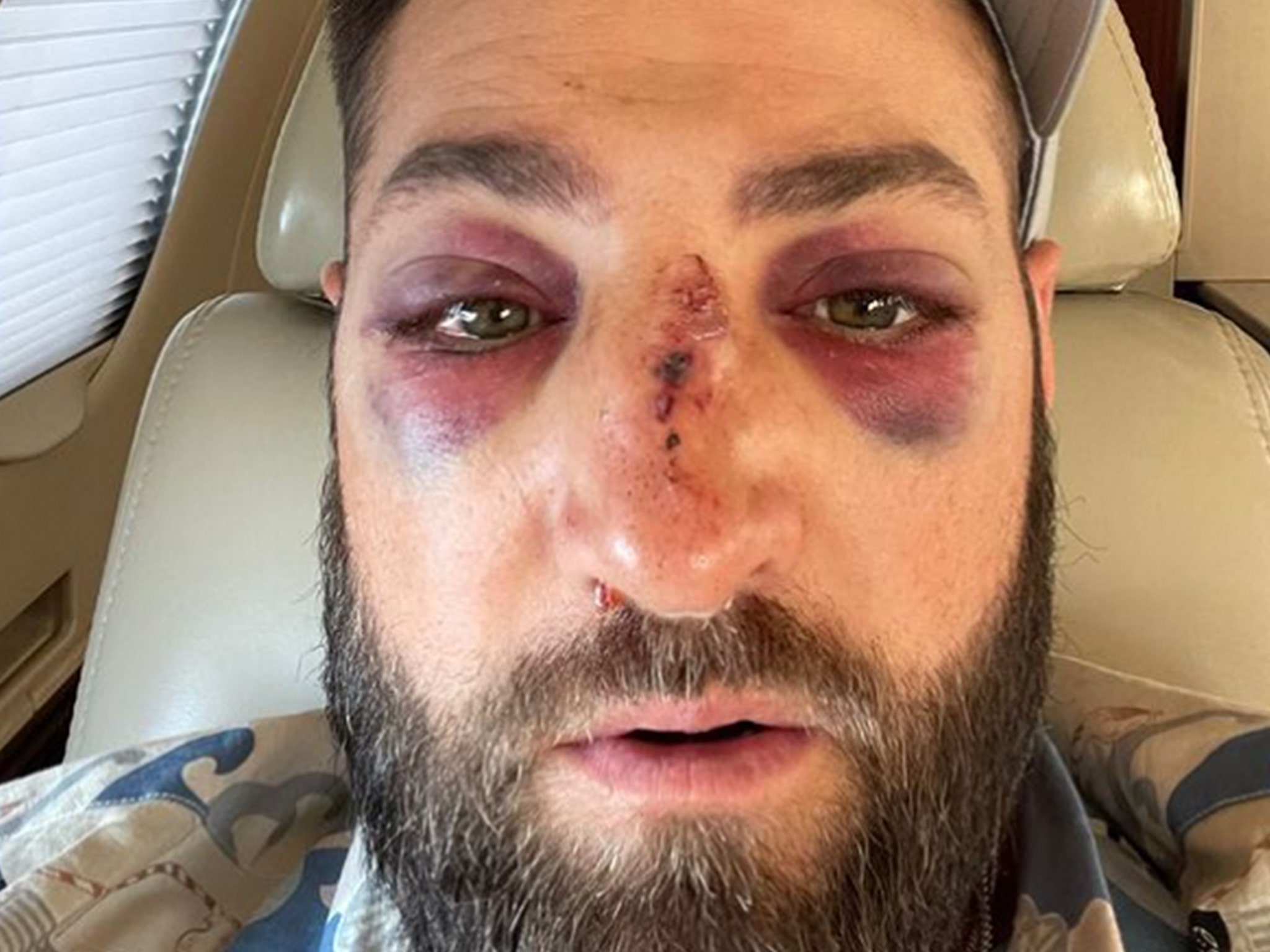 Kevin Pillar Still Swollen, Bloody & Bruised 3 Days After Taking Fastball  To Face