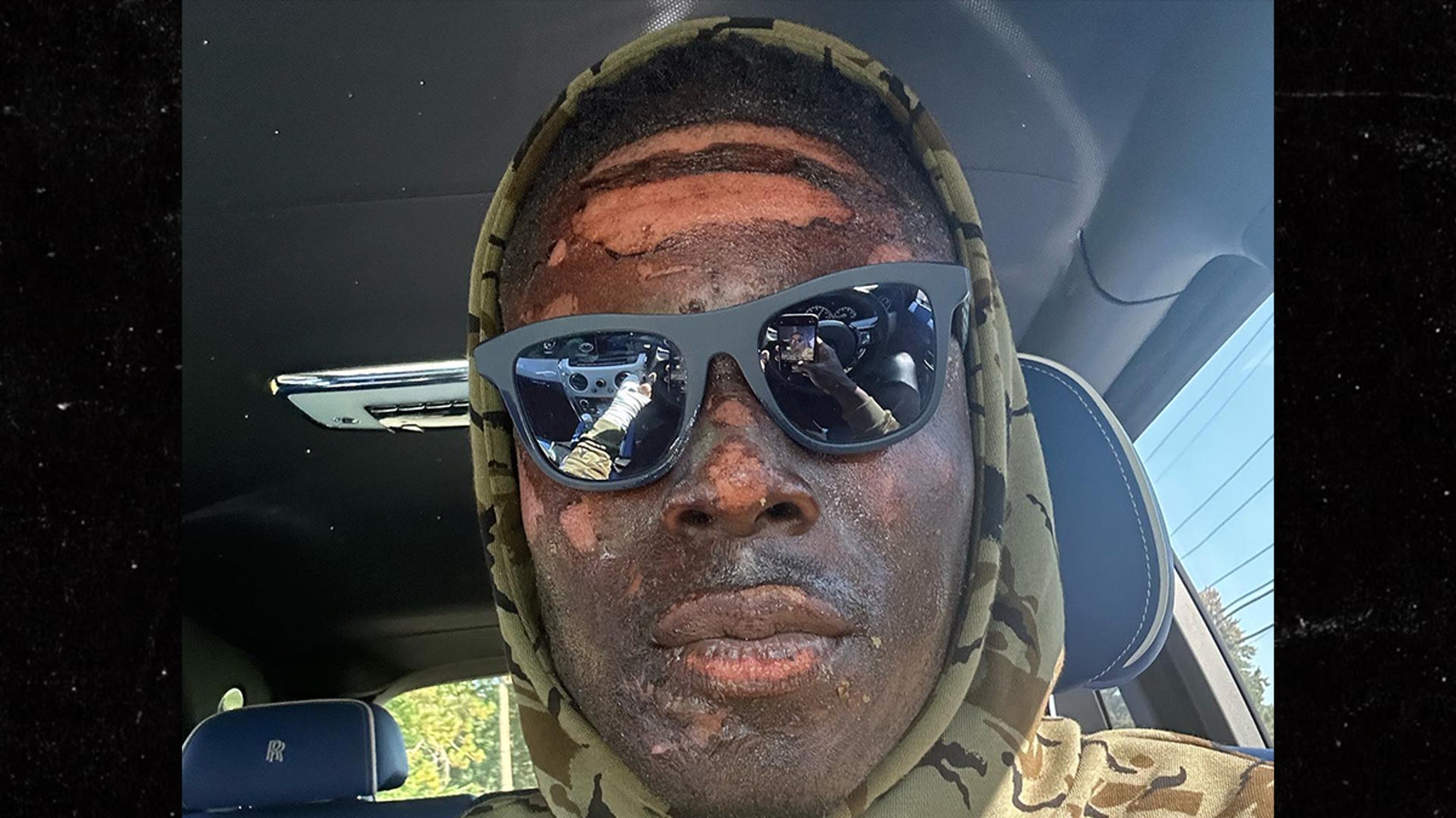 Browns’ David Njoku Reveals Burned Face After Fire Pit Accident