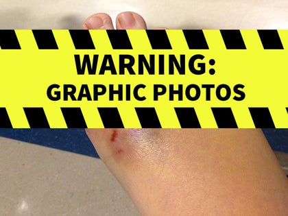 0828-katy-perry-lawsuit-toe-allaged-injuries-photos-primary