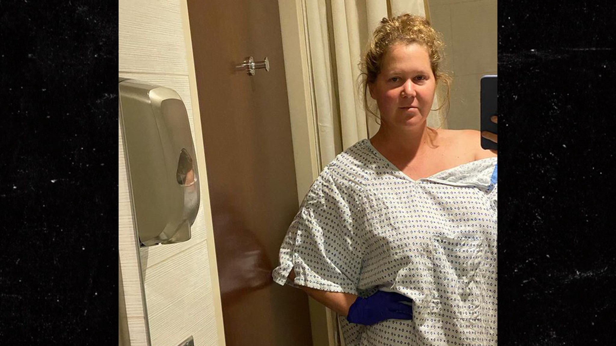 Amy Schumer Has Uterus and Appendix Removed From Endometriosis