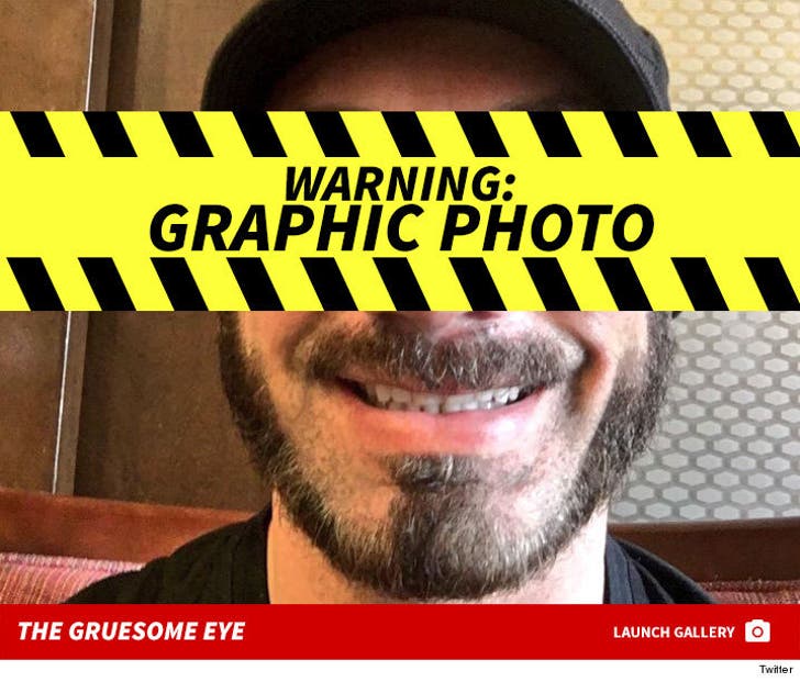 Austin Aries -- The Gruesome Eye Injury