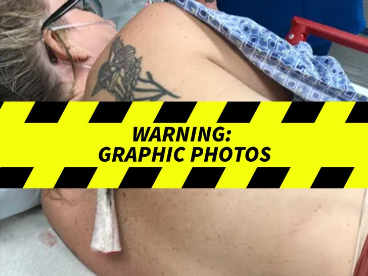 Stingray Impales FL Woman -- Venomous Barb Left In Her Back