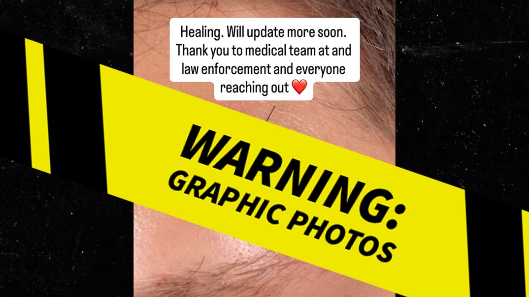 Keegan-Allen-injury-1