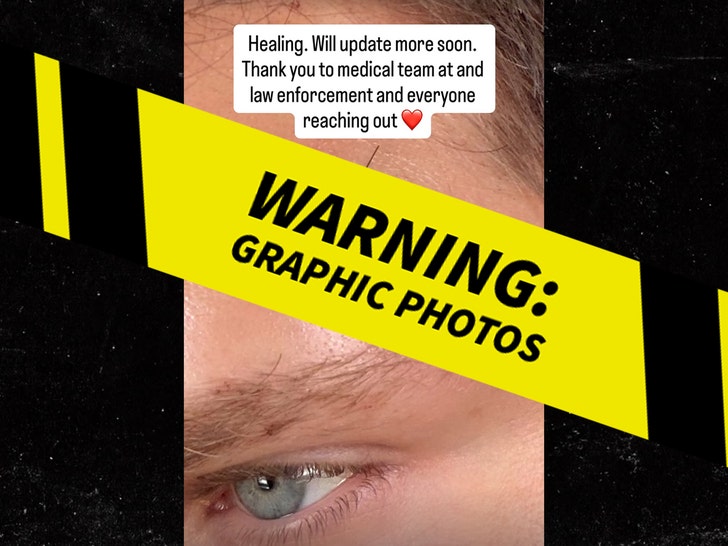 Keegan Allen Injury