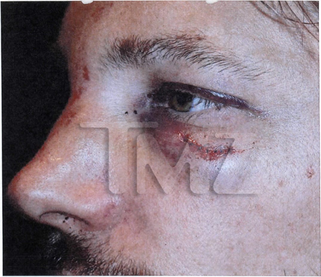 gabriel_aubry_fight_injuries_04