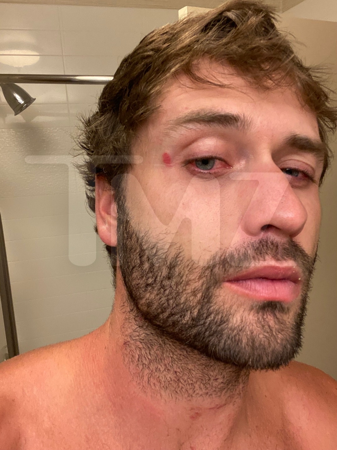 Dakota Mortensen Alleged Injuries 6