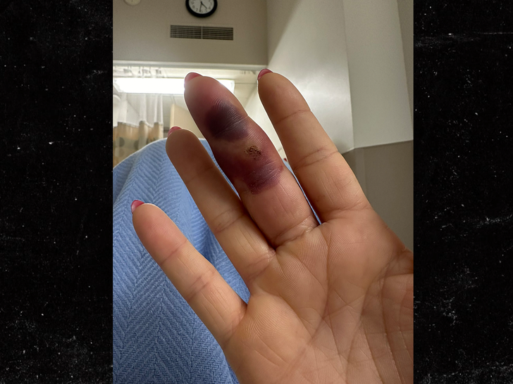 CJ Perry finger infected at hospital