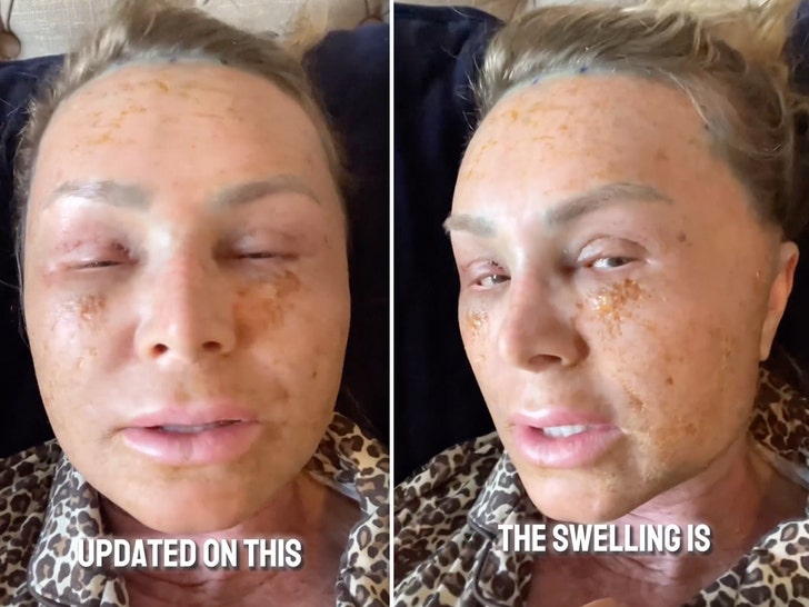 Tamra Judge Documents Brow Lift