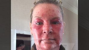 'Queen of Versailles' Jackie Siegel -- Lasers Scorched My Face (Horrifying Photos)