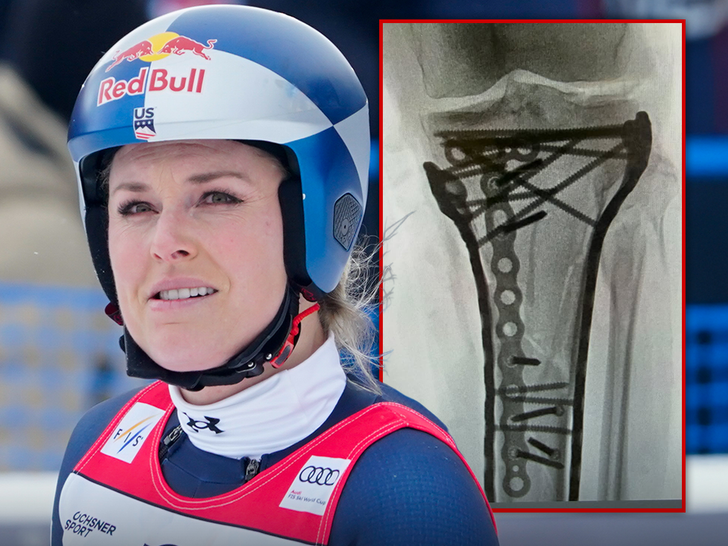 lindsey vonn surgery
