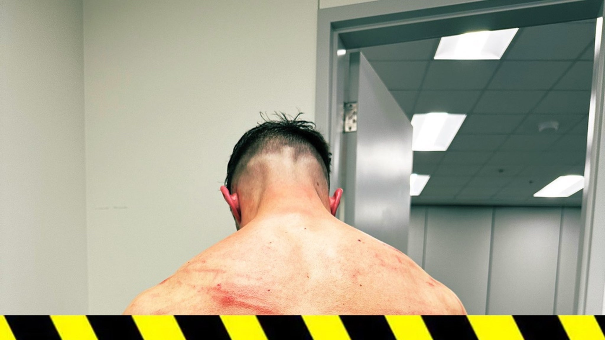 Finn Bálor's Head and Body Injuries Gruesome Pics