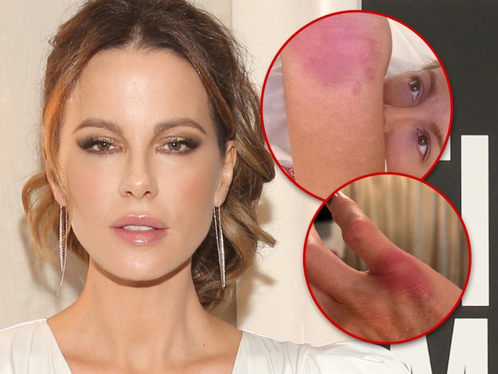 Kate Beckinsale Implies She’s Doing Own Stunts, Posts Gruesome Injury Pics