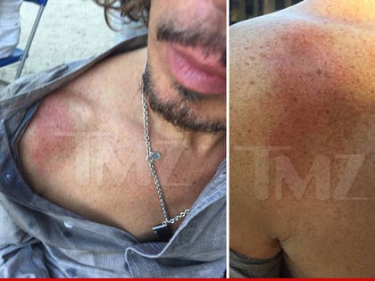 0914-chris-cornell-chemical-burn-TMZ-01