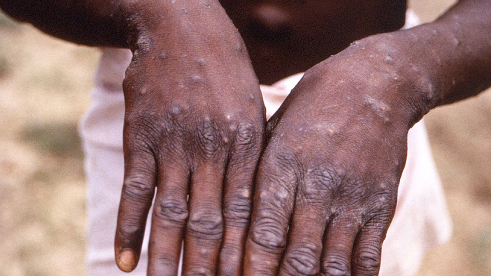 First Case of Monkeypox Virus Detected in United States This Year