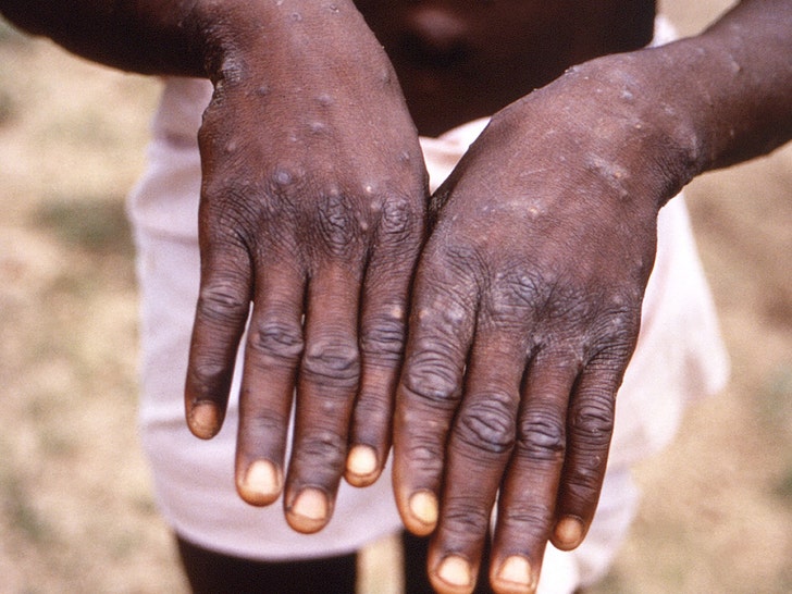 First Case of Monkeypox Virus Detected in United States This Year.jpg