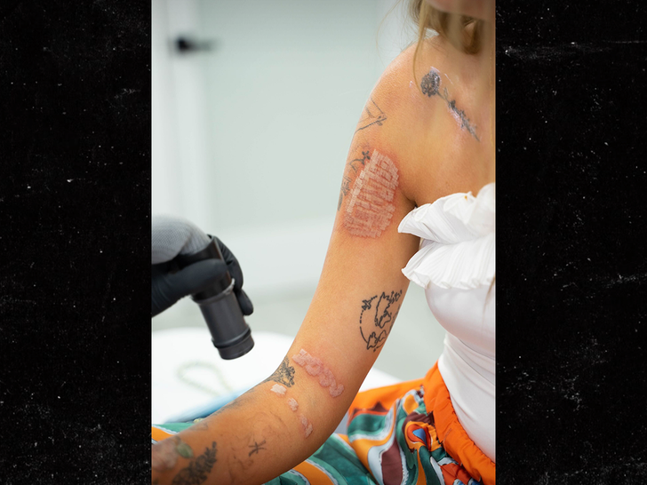 What is nonlaser tattoo removal