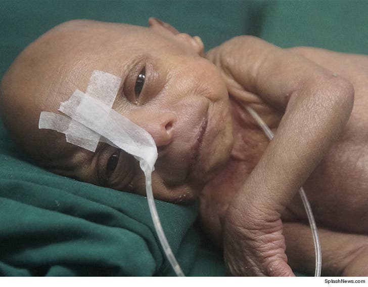 Baby Born In Bangladesh Has Benjamin Button Like Disease Photo