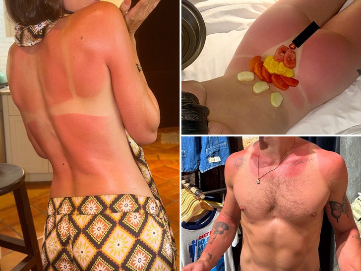 Celebrity Sunburns -- Guess Who!