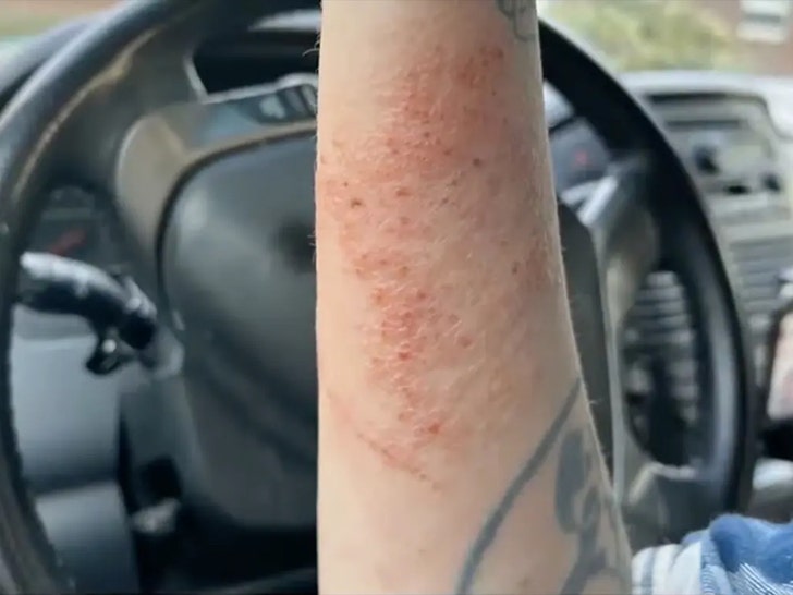 brown recluse spider bite woman