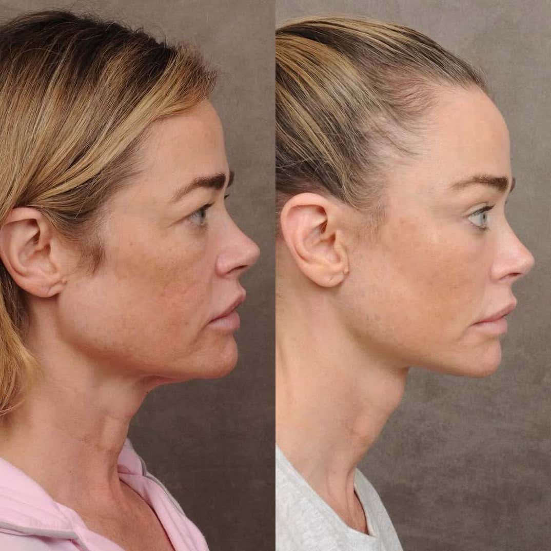 denise richards facelift 5