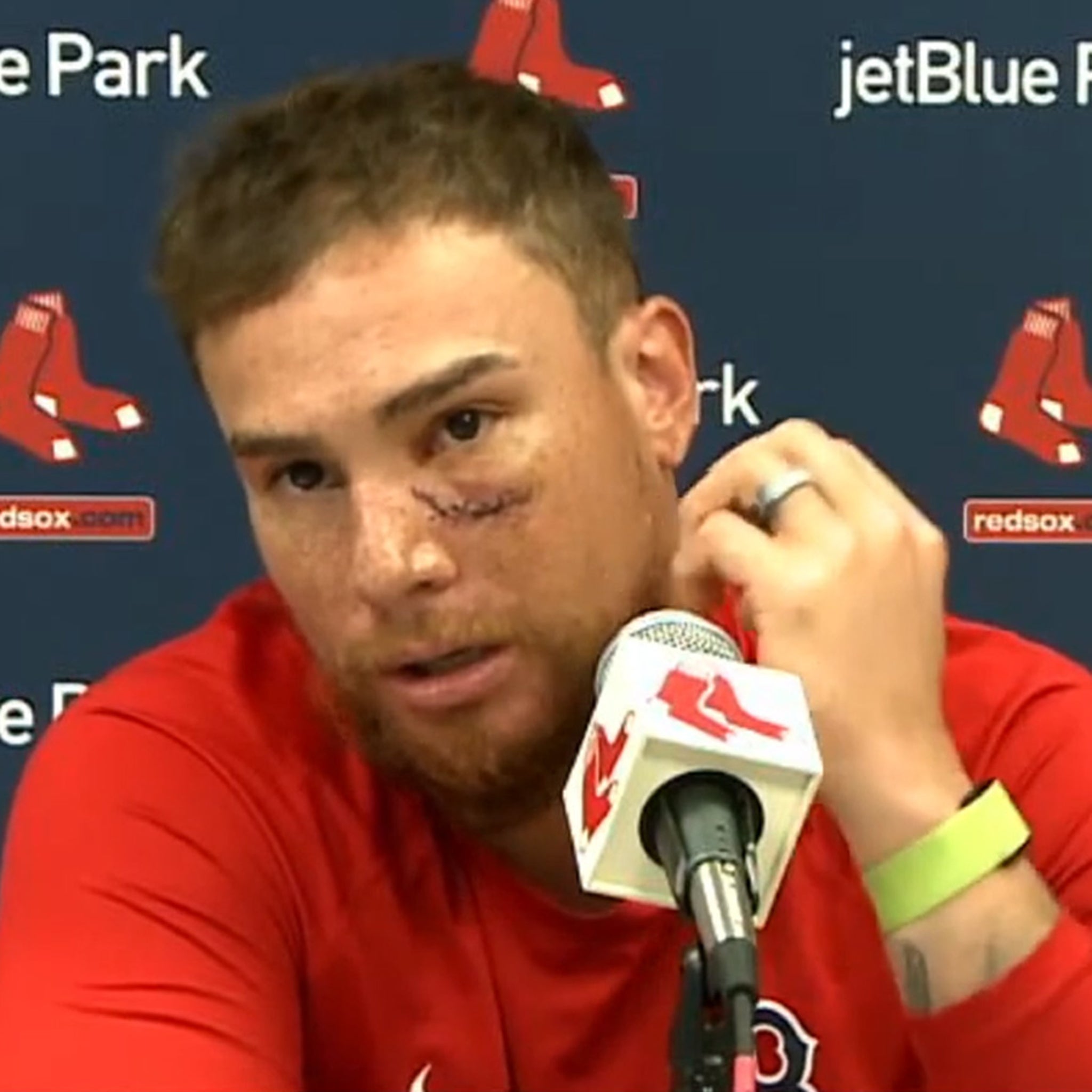 MLB's Christian Vazquez Shows Bloody Scar After Getting Drilled In