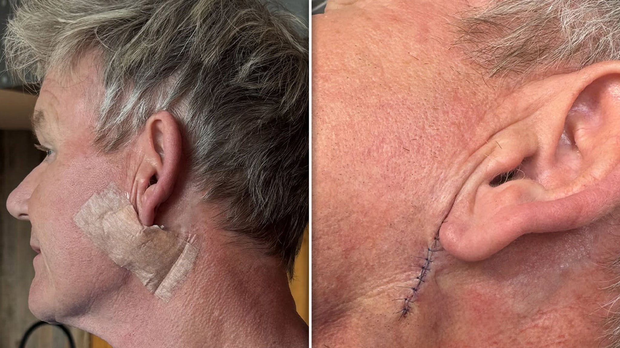 Gordon Ramsay Gets Treatment to Remove Skin Cancer, Shows Surgery Scar