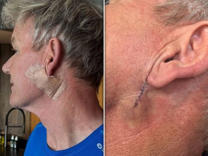 gordon ramsay skin cancer instagram 3