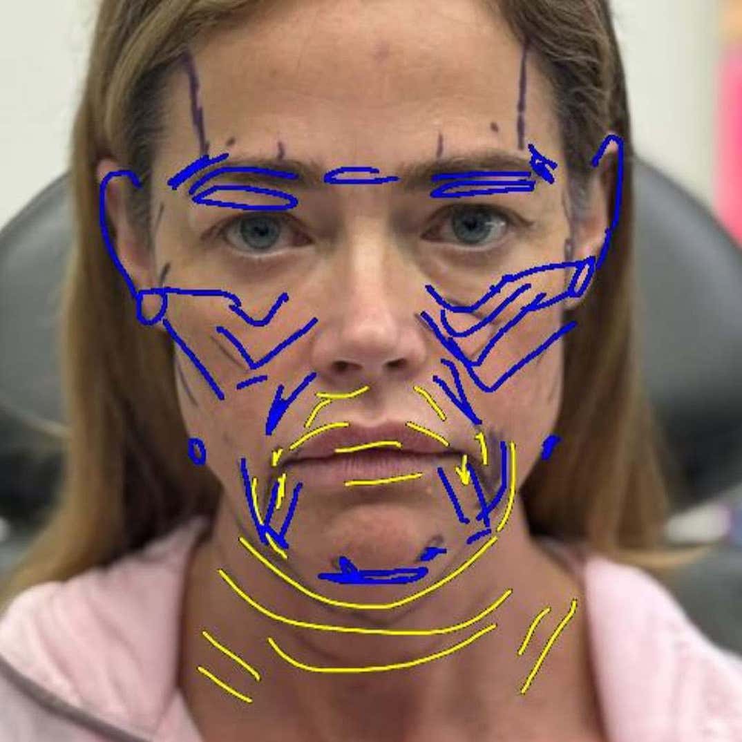 denise richards facelift 1