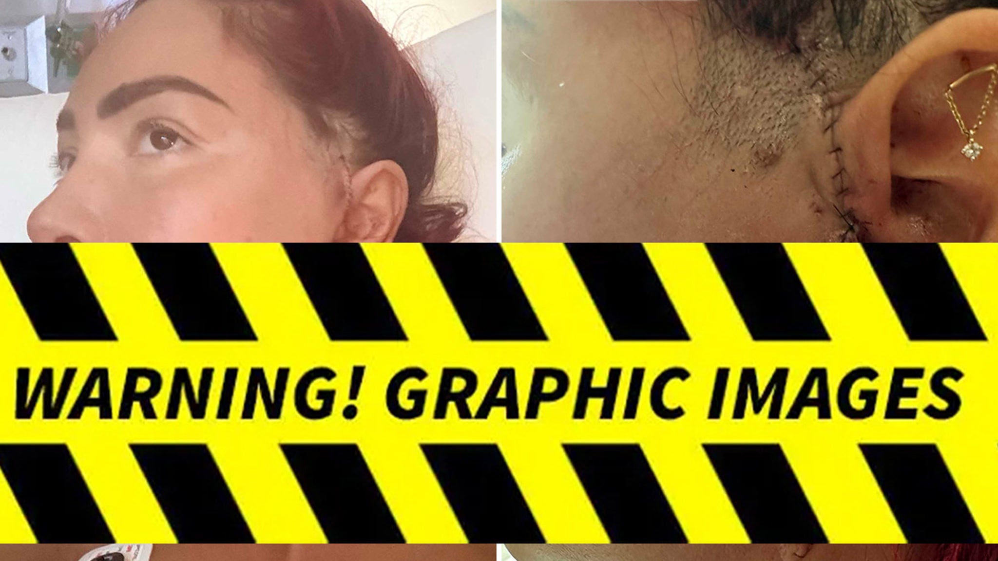 Farrah Abraham's Scary Stitching Revealed After Major Jaw Surgery