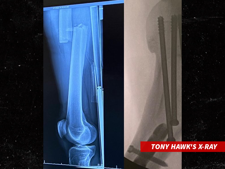 Tony Hawk Reveals 'Major Setback' After Femur Fracture - Parade