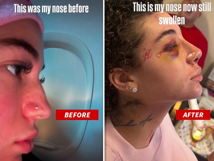 Bhad Bhabie nose job before and after