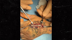 UFC's Anthony Smith Shows Bloody Pic Of Metal Rod In Broken Hand
