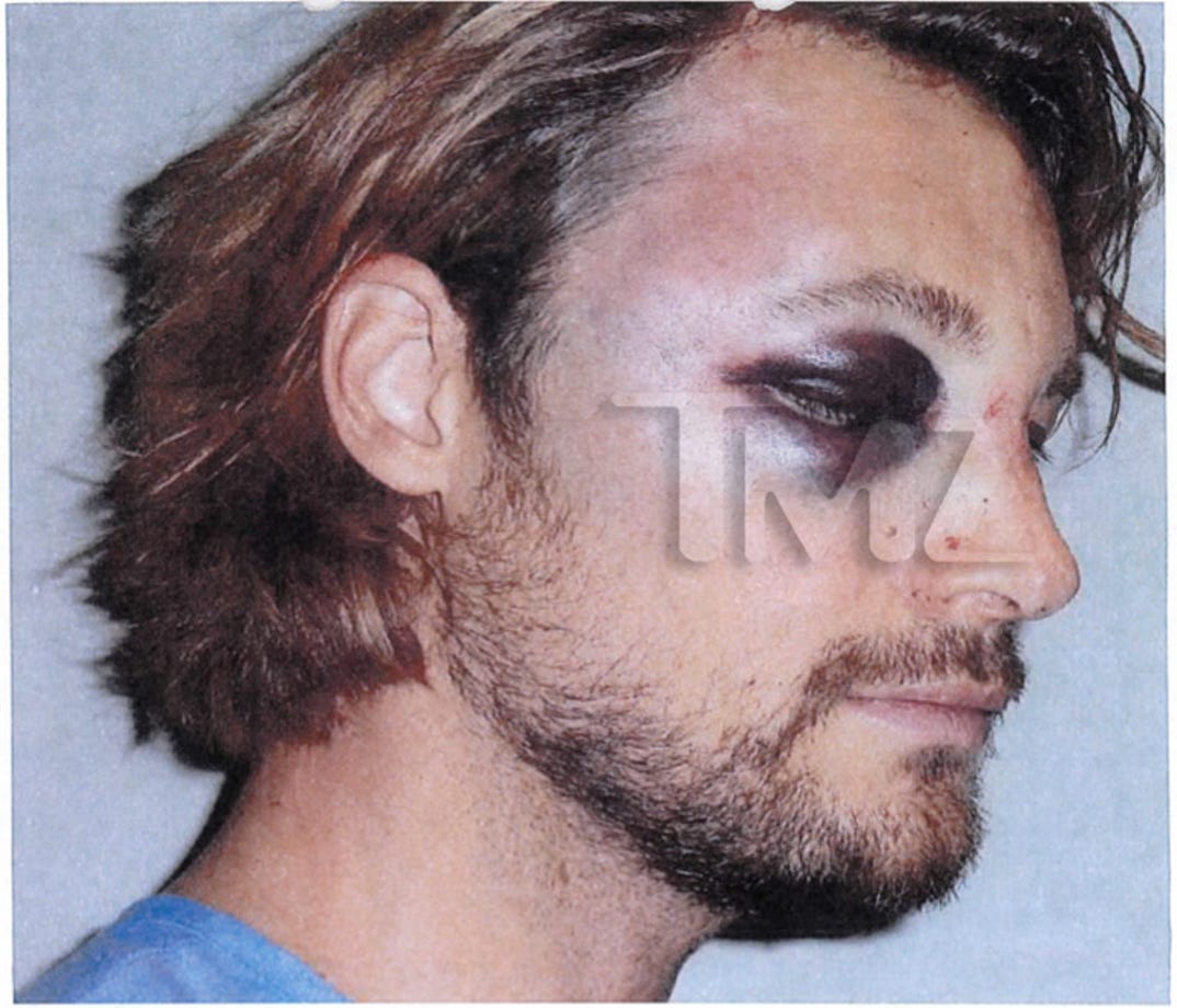 gabriel_aubry_fight_injuries_05