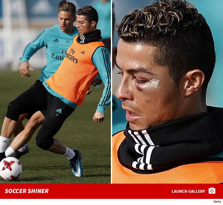 Cristiano Ronaldo Sports Black Eye After Bloody Collision