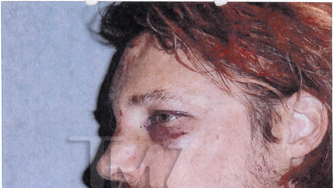 gabriel_aubry_fight_injuries_03
