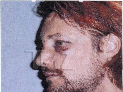 gabriel_aubry_fight_injuries_03