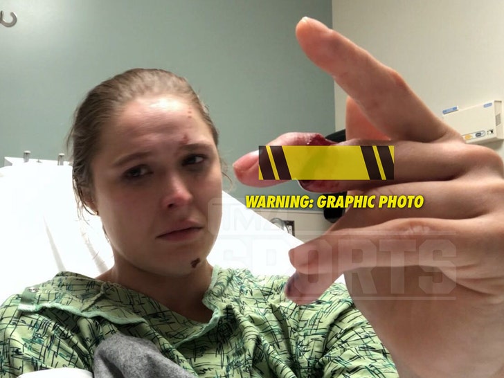 Ronda Rousey's Gruesome Finger Injury