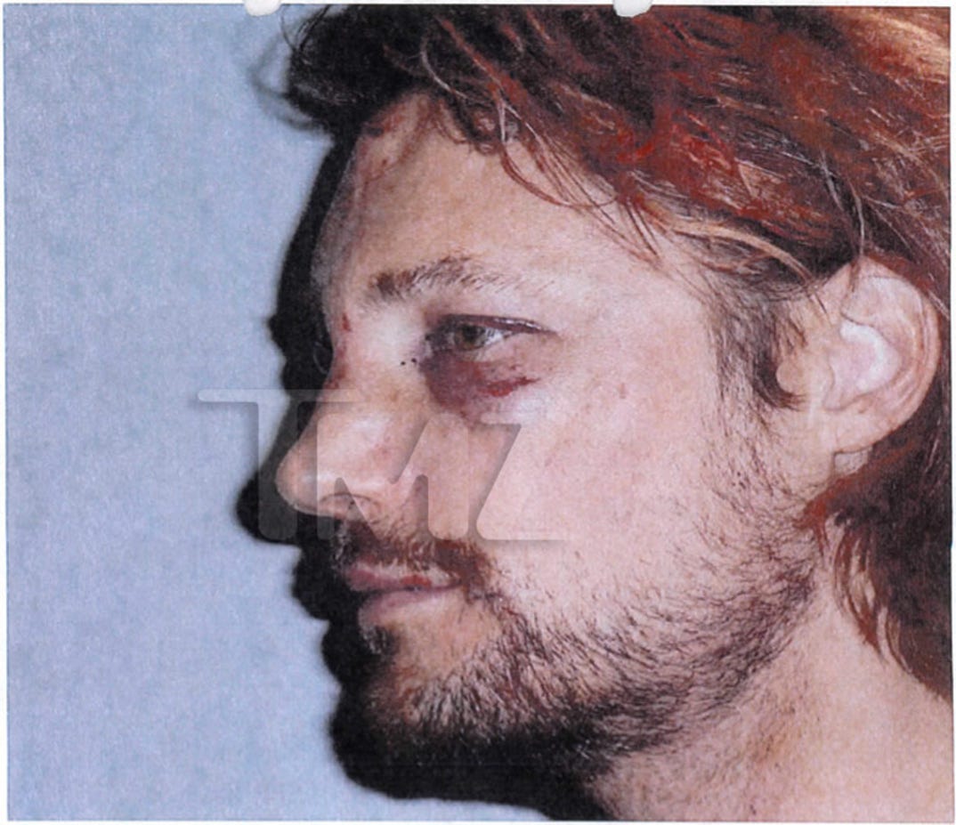 gabriel_aubry_fight_injuries_03