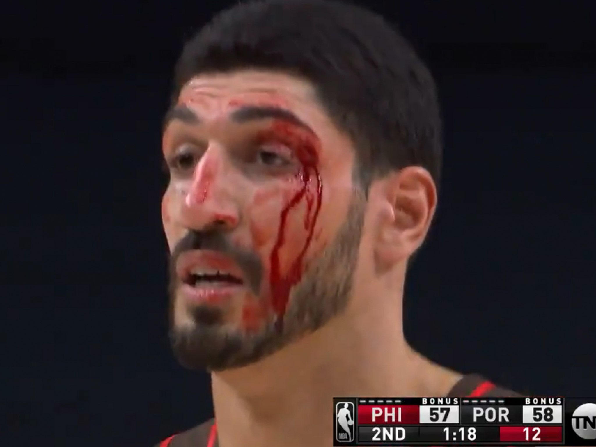 Portland Trail Blazers' Enes Kanter doesn't allow bloody cut above